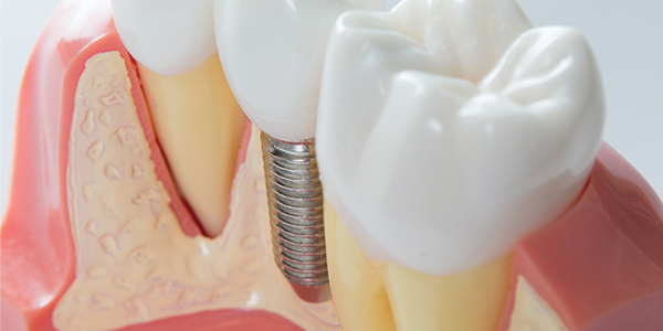 Model of a jaw with tooth implant.